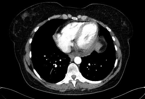 Cardiac sarcoidosis (Radiopaedia 74548-85534 A 63).jpg