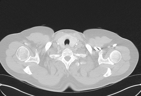 File:Cardiac sarcoidosis (Radiopaedia 74548-85534 Axial lung window 2).jpg