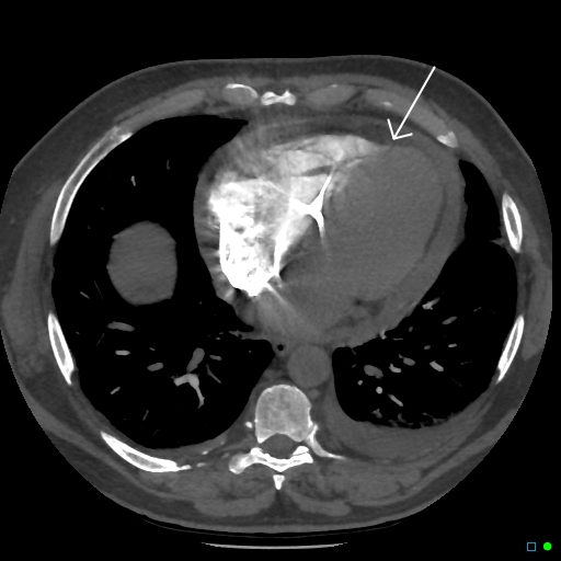 File:Cardiac tamponade (Radiopaedia 20909-20841 D 1).jpg