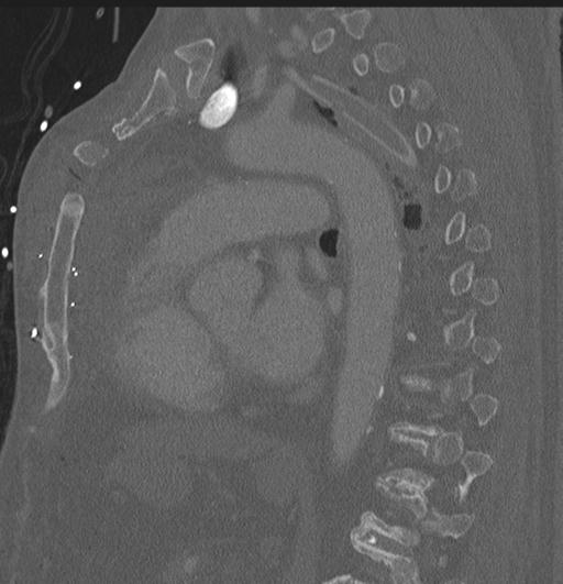 Cardiac trauma (Radiopaedia 32874-33858 Sagittal bone window 23).jpg