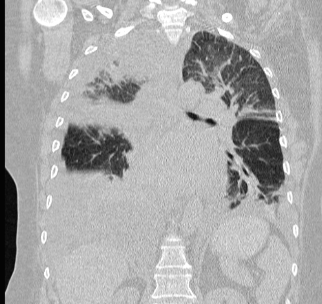 Cardiogenic pulmonary edema (Radiopaedia 29213-29609 Coronal lung window 42).jpg