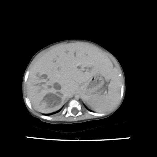Caroli disease with autosomal recessive polycystic kidney disease (ARPKD) (Radiopaedia 89651-106703 B 40).jpg