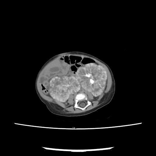 Caroli disease with autosomal recessive polycystic kidney disease (ARPKD) (Radiopaedia 89651-106703 E 160).jpg
