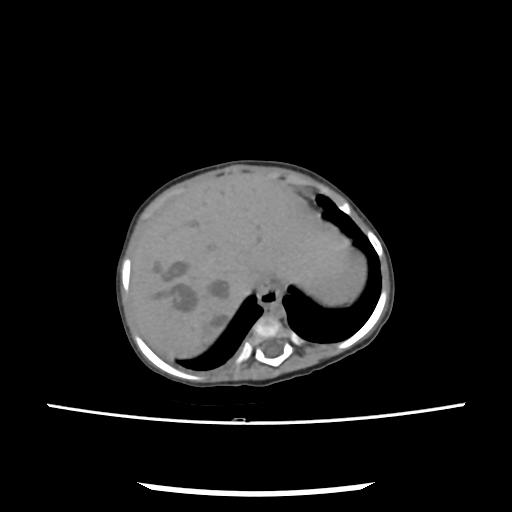 Caroli disease with autosomal recessive polycystic kidney disease (ARPKD) (Radiopaedia 89651-106703 E 27).jpg