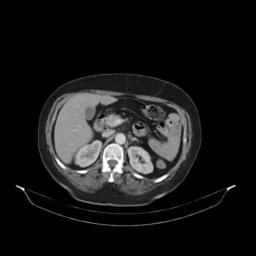 File:Carotid body tumor (Radiopaedia 21021-20948 B 69).jpg