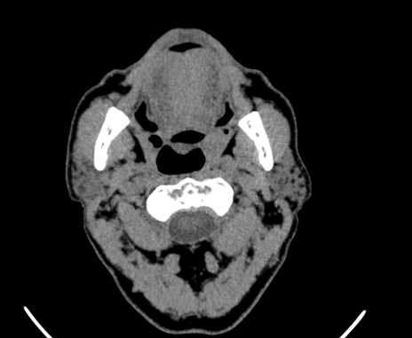Carotid body tumor (Radiopaedia 61750-69757 Axial non-contrast 23).jpg