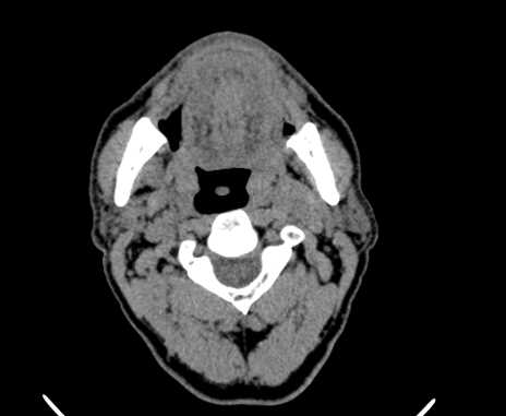 File:Carotid body tumor (Radiopaedia 61750-69757 Axial non-contrast 30).jpg