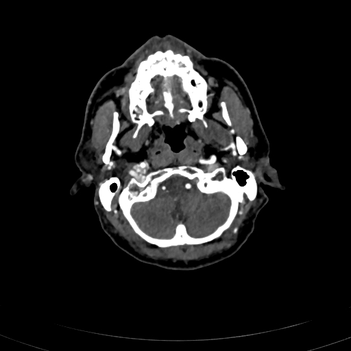 Carotid body tumor (Radiopaedia 83615-98727 A 29).jpg