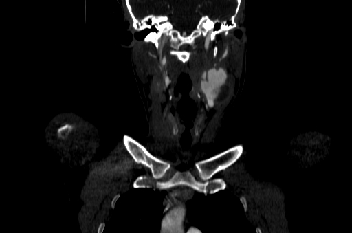 File:Carotid bulb pseudoaneurysm (Radiopaedia 57670-64616 D 15).jpg