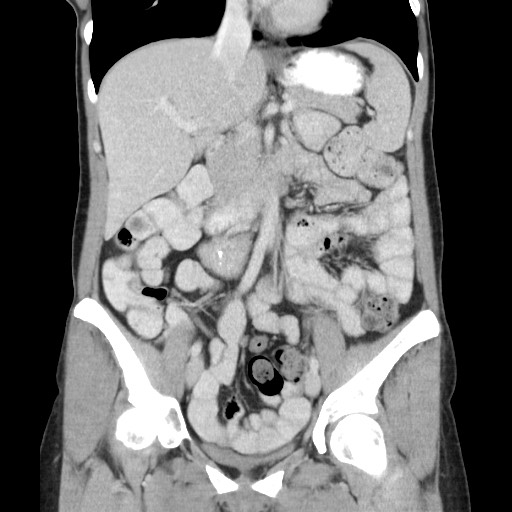 Castleman disease with fibrous pseudotumor in the abdomen (Radiopaedia 77296-89373 B 43).jpg