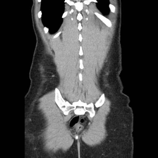 Castleman disease with fibrous pseudotumor in the abdomen (Radiopaedia 77296-89373 B 82).jpg
