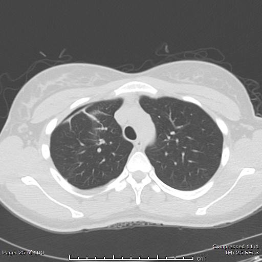 Catamenial pneumothorax (Radiopaedia 54382-60600 Axial non-contrast 25).jpg