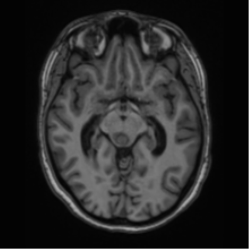 Cavernoma with bleed - midbrain (Radiopaedia 54546-60774 Axial T1 16).png