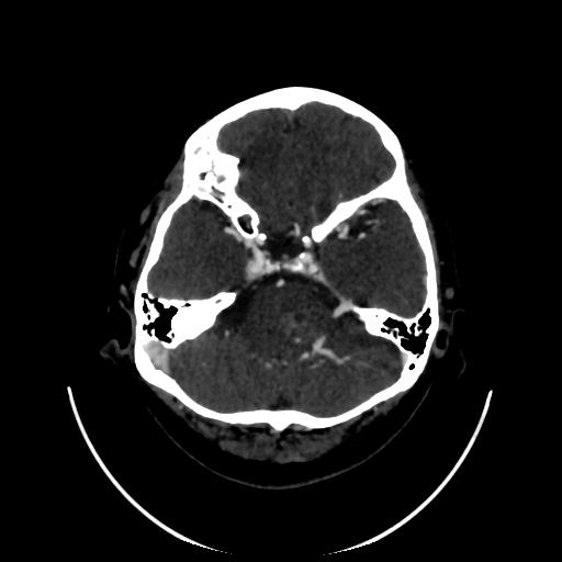 Cavernoma with developmental venous anomaly (Radiopaedia 22470-22506 C 34).jpg