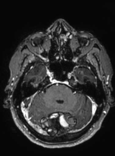 Cavernous hemangioma of the cerebellar falx (Radiopaedia 73025-83724 Axial T1 C+ 243).jpg