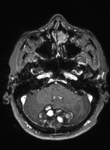 Cavernous hemangioma of the cerebellar falx (Radiopaedia 73025-83724 Axial T1 C+ 259).jpg
