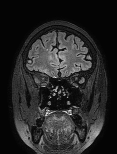 Cavernous hemangioma of the cerebellar falx (Radiopaedia 73025-83724 Coronal FLAIR 72).jpg
