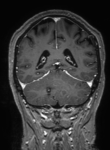 Cavernous hemangioma of the cerebellar falx (Radiopaedia 73025-83724 Coronal T1 C+ 264).jpg