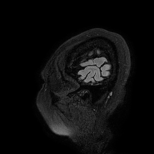 File:Cavernous hemangioma of the cerebellar falx (Radiopaedia 73025-83724 Sagittal FLAIR 3).jpg