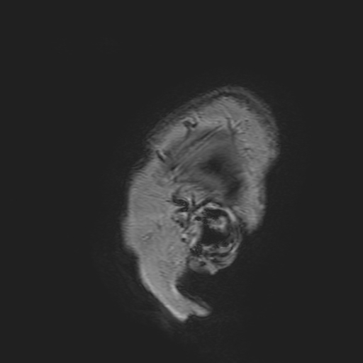 File:Cavernous hemangioma of the cerebellar falx (Radiopaedia 73025-83724 Sagittal T1 4).jpg