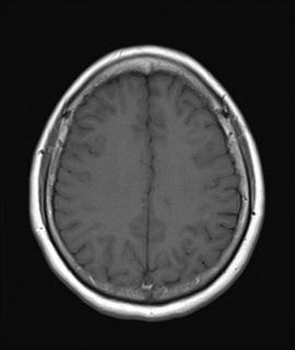 File:Cavernous sinus meningioma (Radiopaedia 63682-72367 Axial T1 16).jpg
