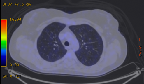 File:Cavitating lung mass - squamous cell carcinoma (Radiopaedia 48047-52853 A 32).png