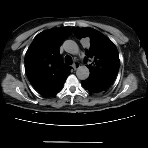 Cavitating pulmonary metastases (Radiopaedia 89545-106544 Axial non-contrast 20).jpg