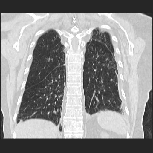File:Cavitating pulmonary metastases (Radiopaedia 89545-106544 Coronal lung window 34).jpg