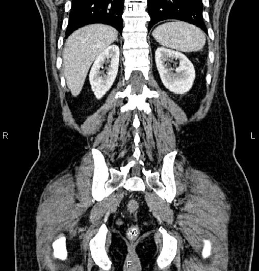 File:Cecal adenocarcinoma (Radiopaedia 85324-100916 D 52).jpg