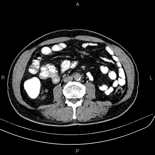 File:Cecal cancer with appendiceal mucocele (Radiopaedia 91080-108651 Axial C+ delayed 37).jpg
