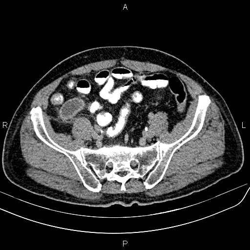 File:Cecal cancer with appendiceal mucocele (Radiopaedia 91080-108651 Axial C+ delayed 60).jpg