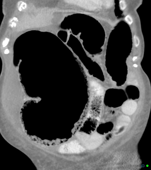 File:Cecal distension and secondary ischemia (Radiopaedia 19824-19874 D 1).jpg