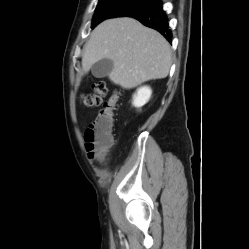 Cecal mass causing appendicitis (Radiopaedia 59207-66531 C 12).jpg