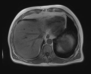File:Cecal mass causing appendicitis (Radiopaedia 59207-66532 Axial T1 in-phase 26).jpg