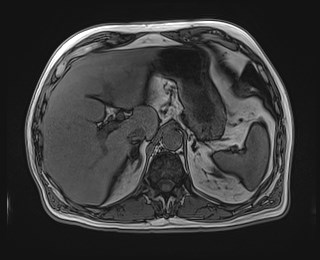 Cecal mass causing appendicitis (Radiopaedia 59207-66532 D 36).jpg