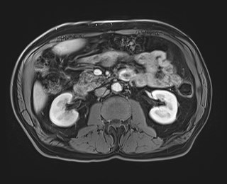 Cecal mass causing appendicitis (Radiopaedia 59207-66532 T1 C+ PV phase 63).jpg