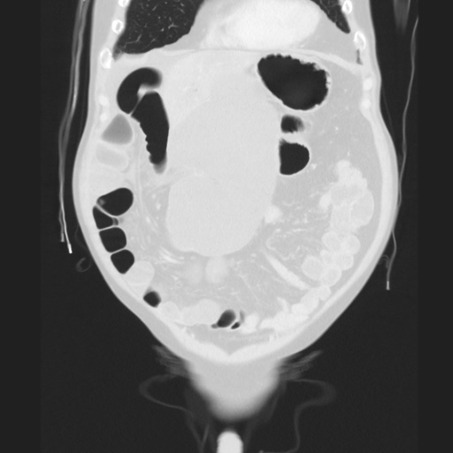 Cecal volvulus (Radiopaedia 75378-86620 Coronal lung window 46).jpg