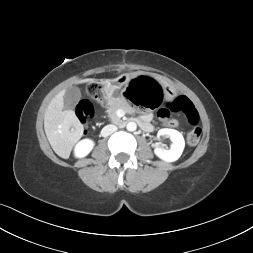 Cecum hernia through the foramen of Winslow (Radiopaedia 46634-51112 A 33).png