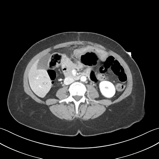 Cecum hernia through the foramen of Winslow (Radiopaedia 46634-51112 A 36).png