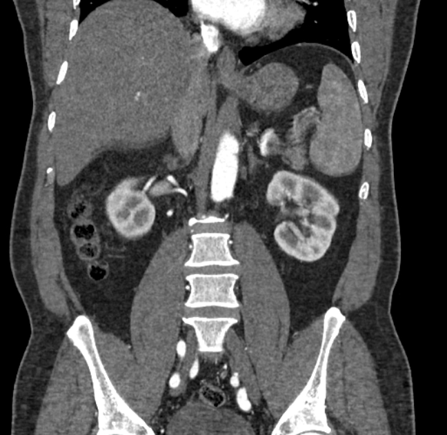 Celiac artery dissection (Radiopaedia 52194-58080 C 78).jpg