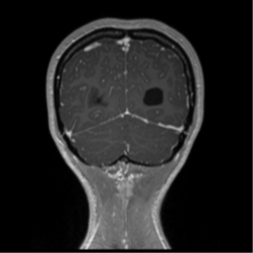 Central neurocytoma (Radiopaedia 37664-39557 Coronal T1 C+ 16).png