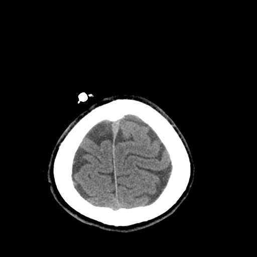 Central neurocytoma (Radiopaedia 68725-78432 Axial non-contrast 49).jpg