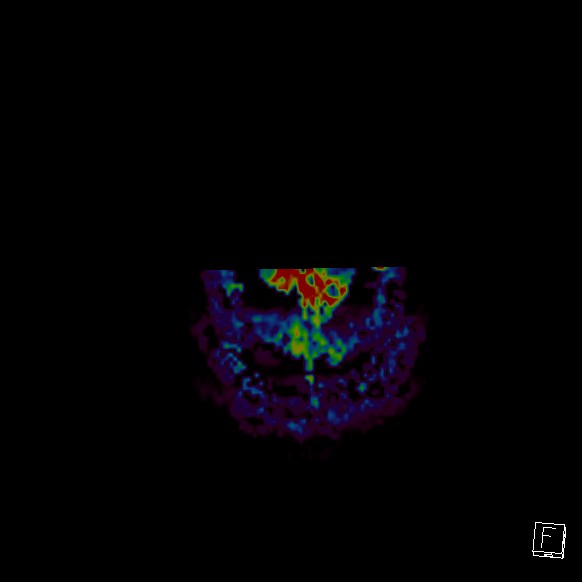 File:Central neurocytoma (Radiopaedia 84497-99872 Axial Perfusion 4).jpg