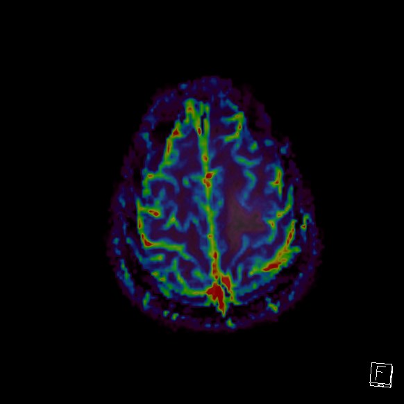 Central neurocytoma (Radiopaedia 84497-99872 Axial Perfusion 44).jpg