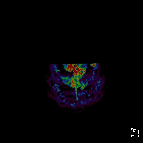 Central neurocytoma (Radiopaedia 84497-99872 Axial Perfusion 6).jpg