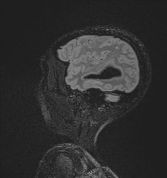 File:Central neurocytoma (Radiopaedia 84497-99872 Sagittal Flair + Gd 125).jpg