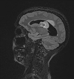 File:Central neurocytoma (Radiopaedia 84497-99872 Sagittal Flair + Gd 56).jpg