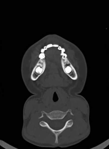 Cerebellar abscess (Radiopaedia 73727-84527 Axial bone window 1).jpg