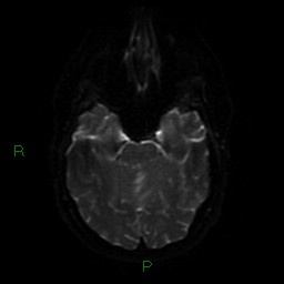 Cerebellar abscess (Radiopaedia 78135-90678 Axial DWI 41).jpg