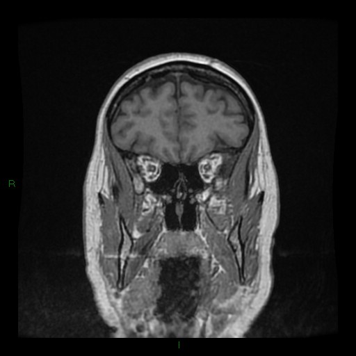 Cerebellar abscess (Radiopaedia 78135-90678 Coronal T1 C+ 39).jpg